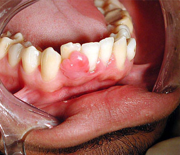 Oral cavity - Irritation fibroma - Pathology Outlines