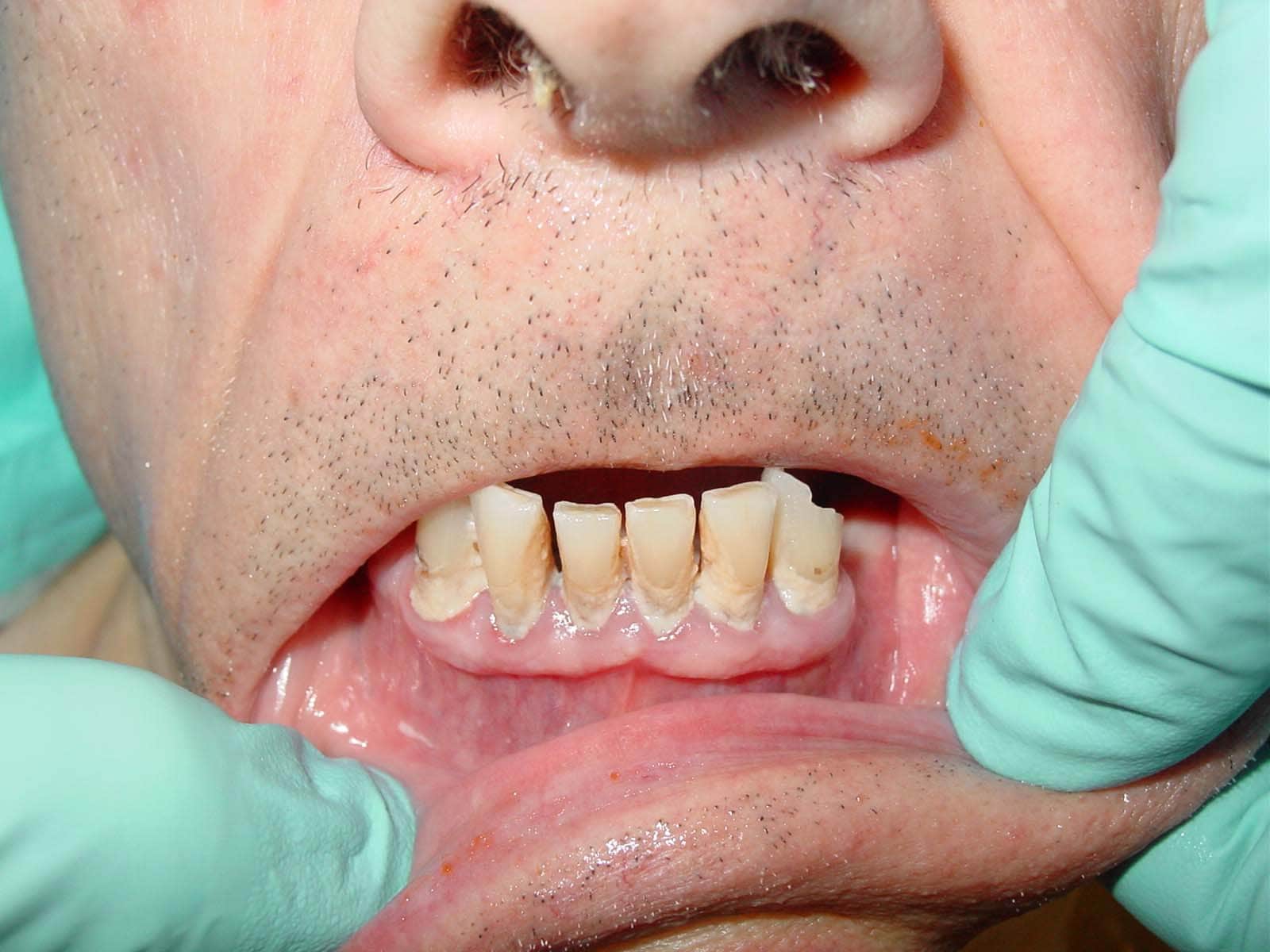A 72-year-old man with severe  periodontal disease...