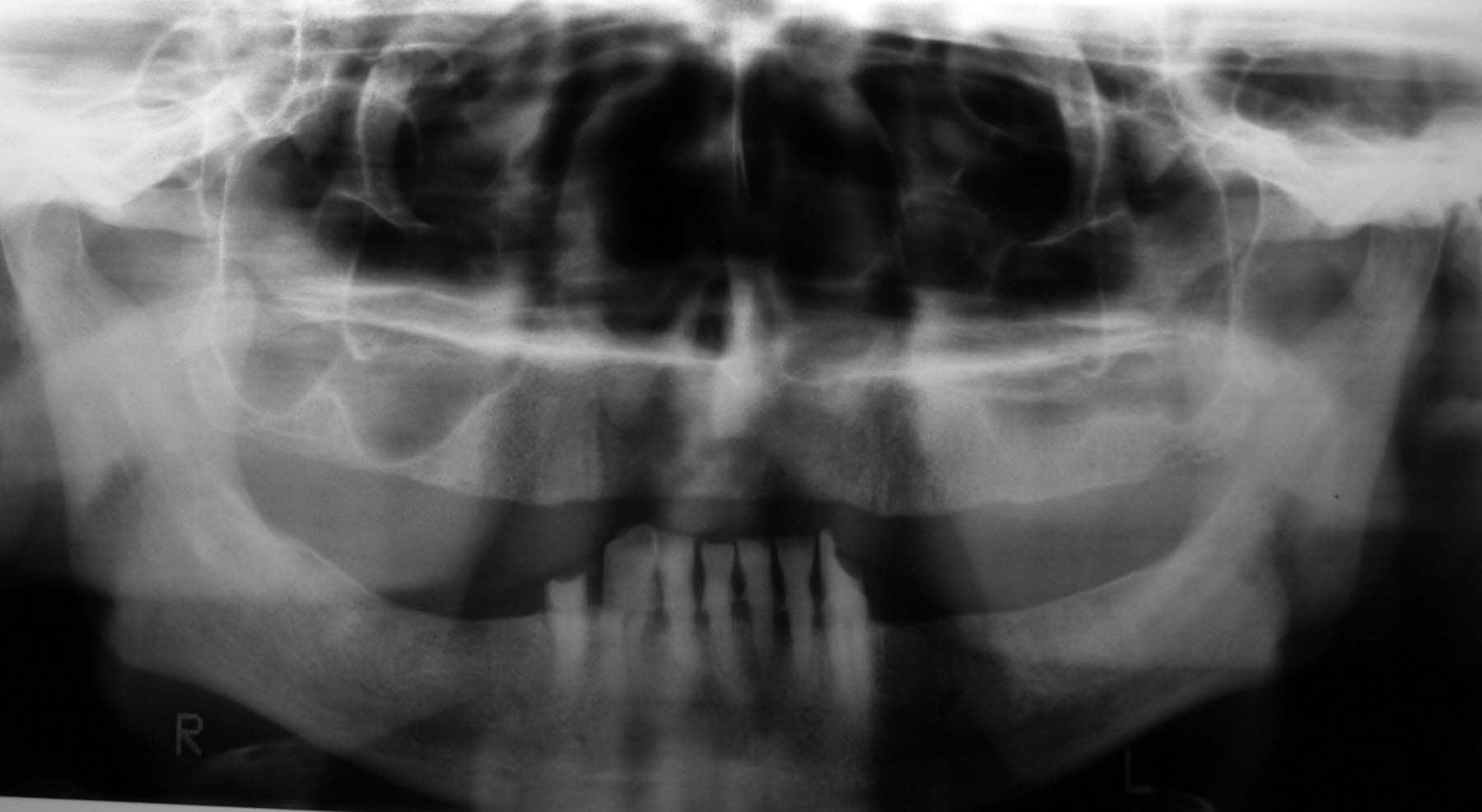 Radiographically evident severe  alveolar bone los...