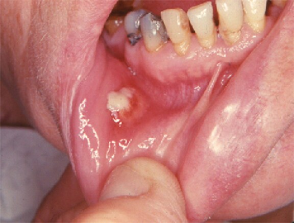 Image shows an oral fistula