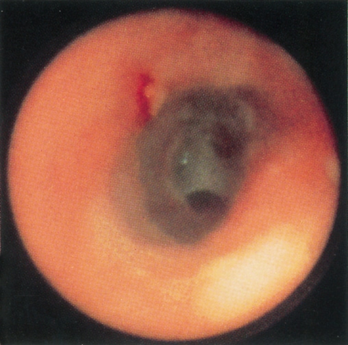 Postcricoid web in a patient with Plummer-Vinson syndrome.