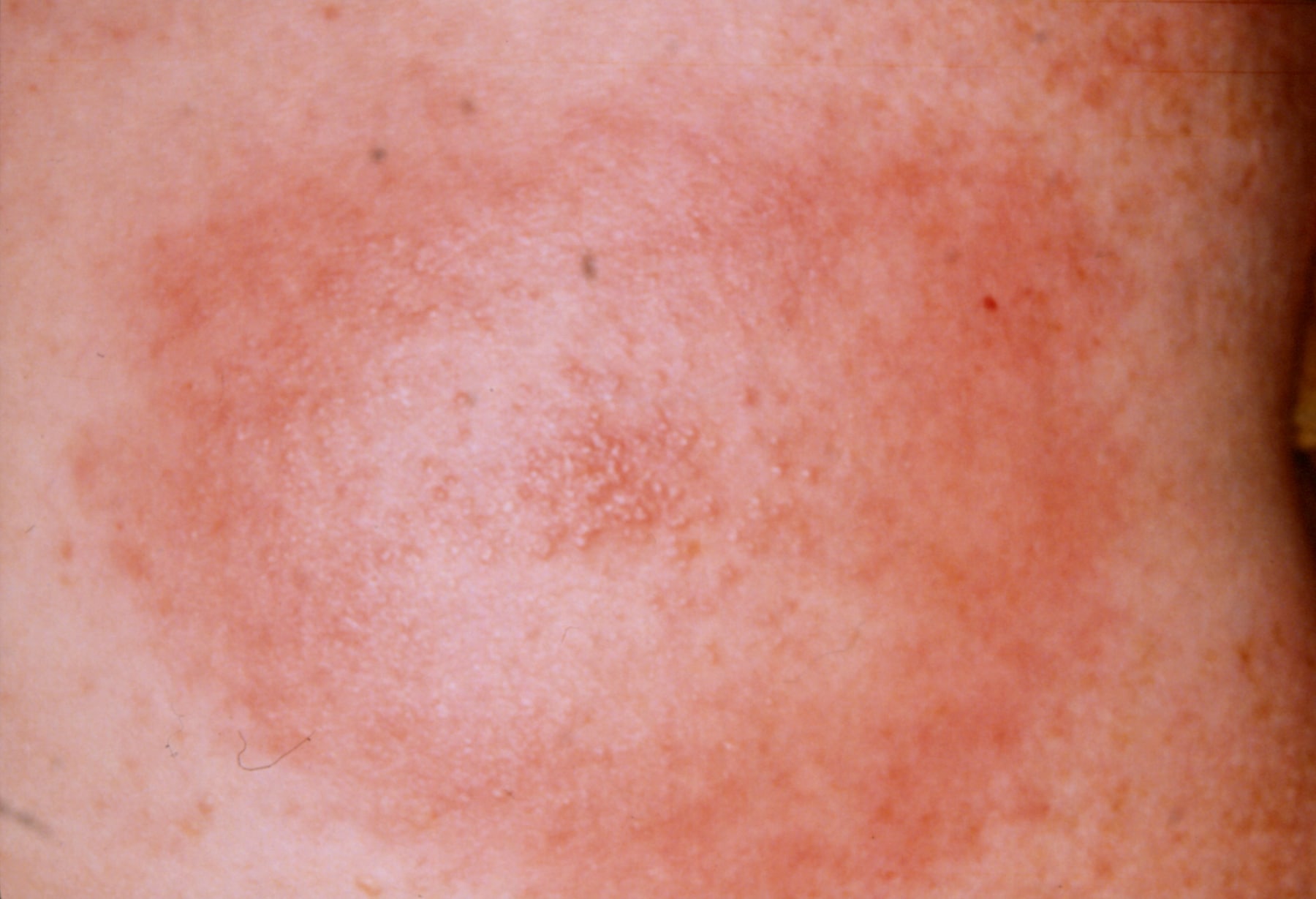 Erythema chronicum migrans (ziekte van Lyme, tekenbeet)