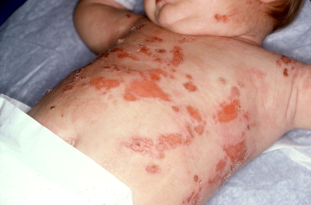 Diffuse cutaneous mastocytosis | Genetic and Rare Diseases ...