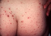 Typical hemorrhagic crusted papules of pityriasis...