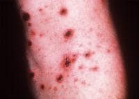 Close-up view of typical lesions of pityriasis li...