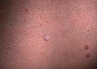 Close-up view of typical pityriasis lichenoides c...