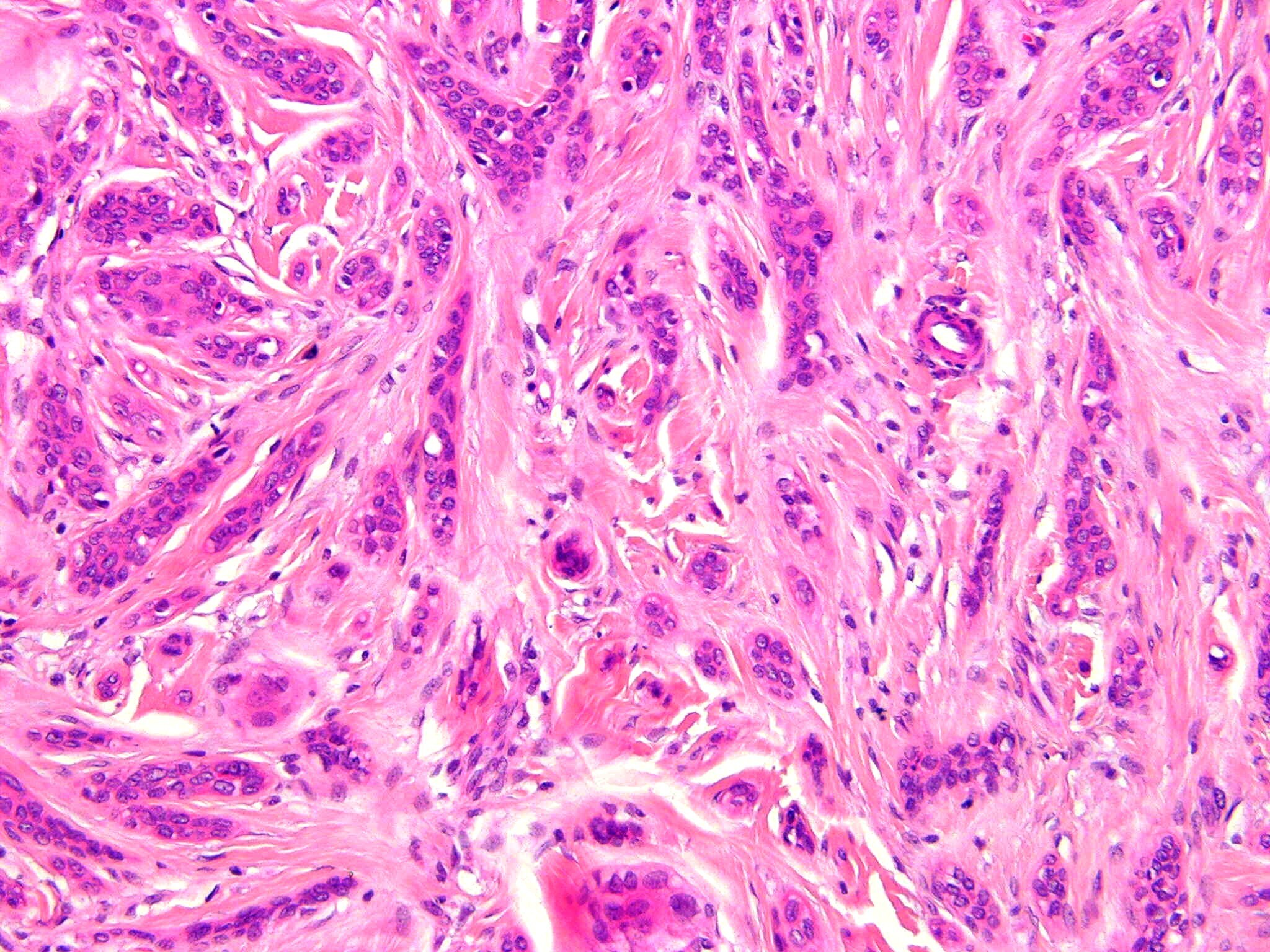 Carcinoma of pictures squamous cell Carcinoma of pictures squamous cell