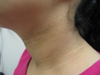 Acanthosis Nigricans Children