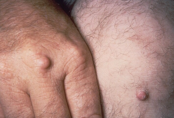 xantoame tuberoase