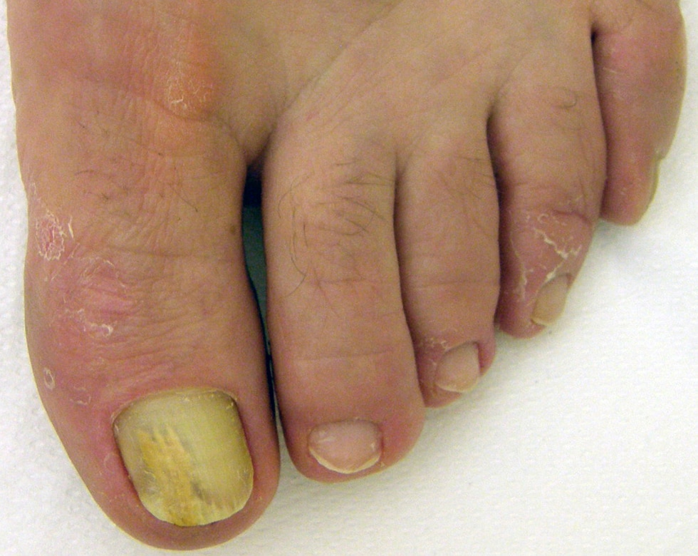 onycholysis treatment