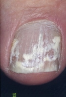 Endonyx Onychomycosis