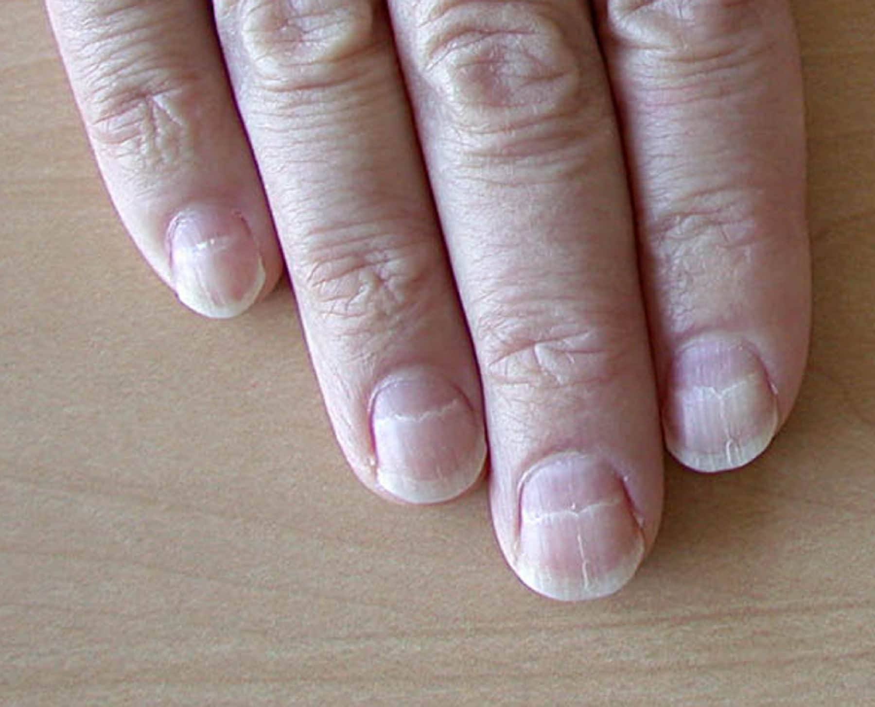 Do Nails That Crack & Split Down the Center Indicate ...