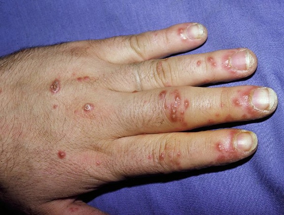 Painful erosions on the fingers in a patient with reactive arthritis.