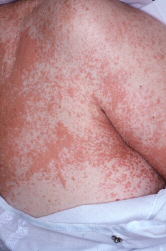 Pityriasis Rubra Pilaris: eMedicine Dermatology