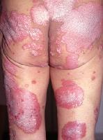 La préparation pour le traitement du psoriasis novartis