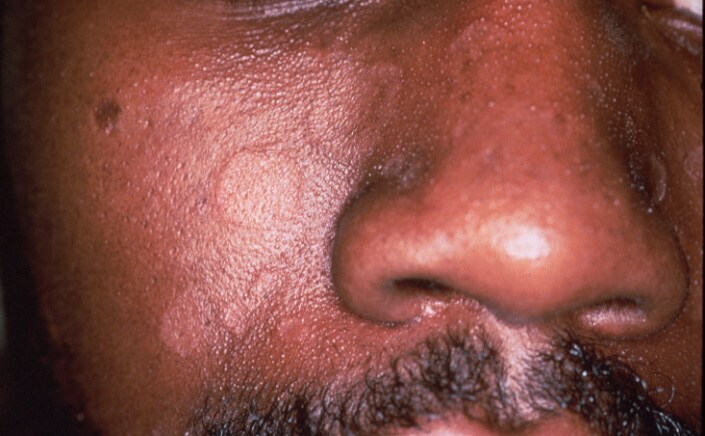  darker-skinned races are susceptible to annular seborrheic dermatitis, 