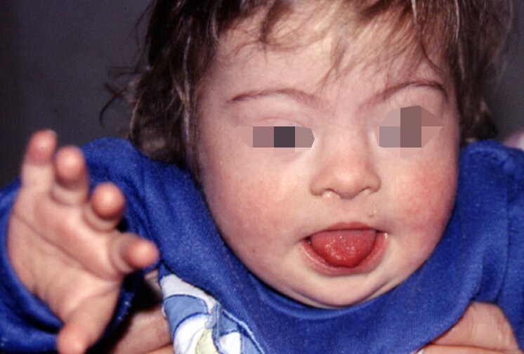 treatments for down syndrome. Down Syndrome: eMedicine .