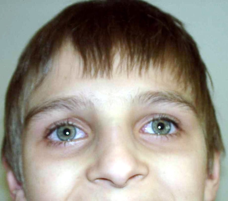 Face of a boy with ataxia-telangiectasia. Apparent ocular telangiectasia.