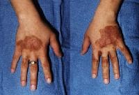 Hyperpigmented streaks on the dorsa of hands of a 
