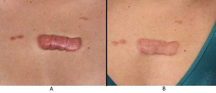 Keloid scar on the anterior chest before (A) and .