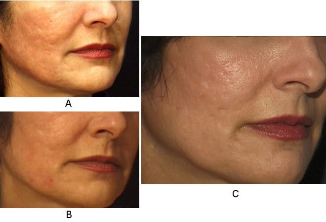 Atrophic acne scars before full-face carbon dioxi.