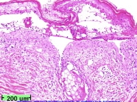 Low-power view showing full-thickness epidermal ne