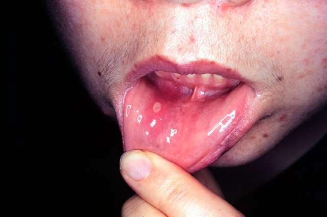Herpes Simplex: Causes, Symptoms & Diagnosis - Healthline