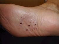 Discrete yellow pustules on the sole of the foot....