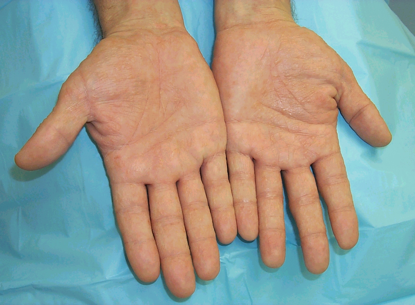 Dry Cracking Skin on the Hands & Fingers | LIVESTRONG.COM