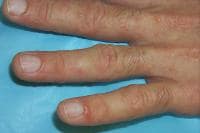 Small, discrete, coalesced vesicles on the finger...