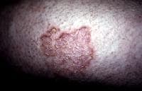 Dry, scaling plaque of nummular dermatitis (size, 