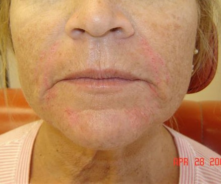 deep frown lines, parallel smile lines, deep nasolabial folds. Dr. Bader injected CosmoDerm I (1 mL) into the nasolabial folds,
