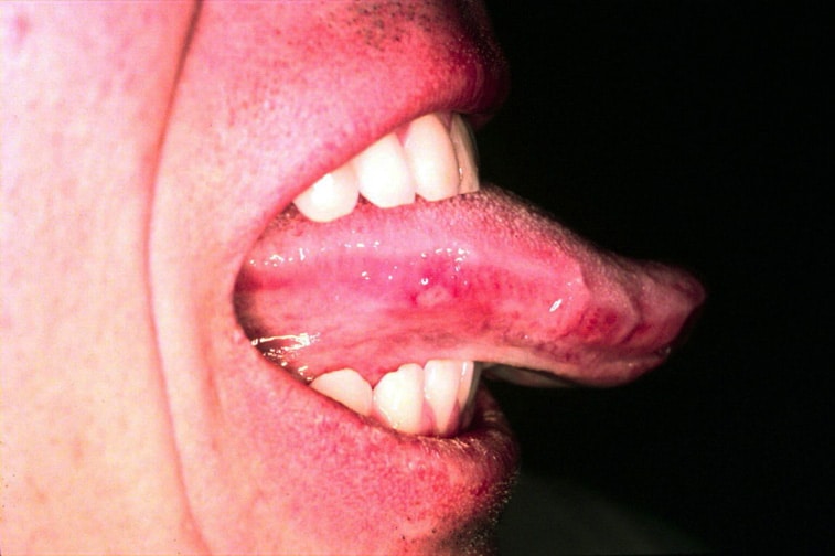 ulcers on tongue. What Causes Tongue Ulcers