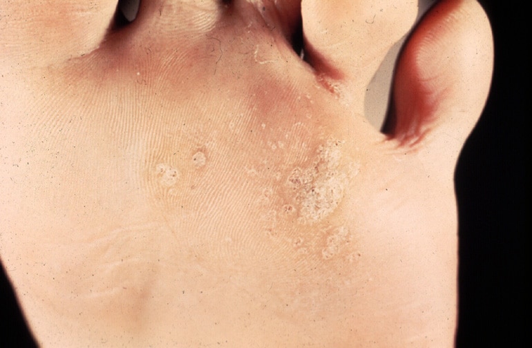 planters warts on feet. Plantar warts can be very