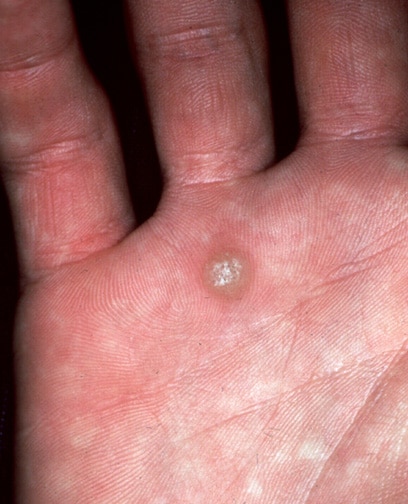 common wart on foot. images common wart on hand.
