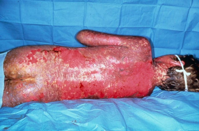 Note extensive sloughing of epidermis from Stevens-Johnson syndrome.
