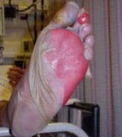 Sheetlike desquamation on the foot in a patient w...