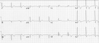 Wellens Syndrome