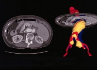 Enhanced spiral CT scans with multiplanar reconstr