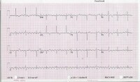 Atrial Block