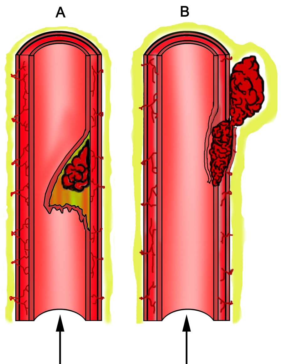 What is a Carotid Artery Dissection? My Summary on what the hell it is