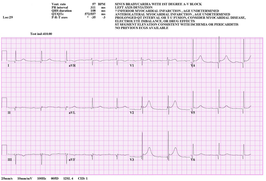 ECG in a patient with first-degree heart block.