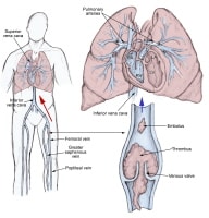 The pathophysiology of pulmonary embolism. Althou...