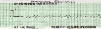 ventricular fibrillation pulseless electrical activity ecg
