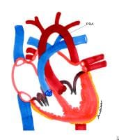 Patent ductus arteriosus.