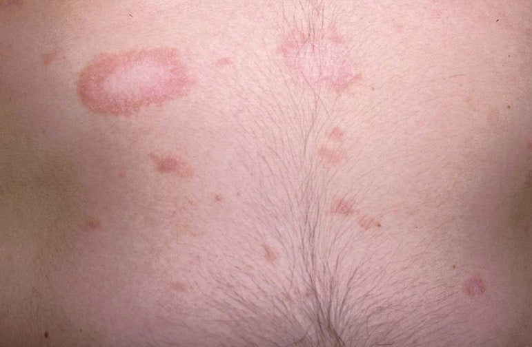 Steroid Rash