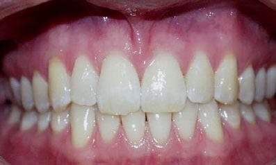 Healthy mouth and gingiva. Note  the healthy light...