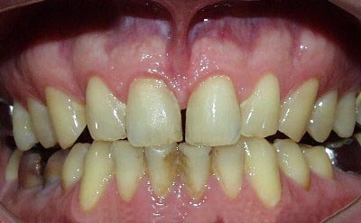 Moderate chronic gingivitis.  Note that the papill...