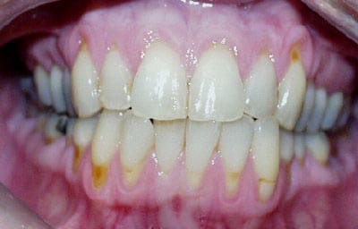 Severe periodontal disease. Loss  of the gingival ...