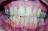 Severe periodontal disease. Loss of the gingival ...